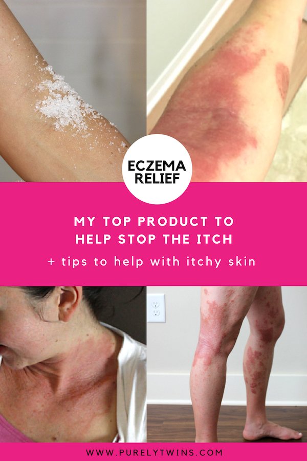 How to help stop the itch {My Secret Eczema tips}
