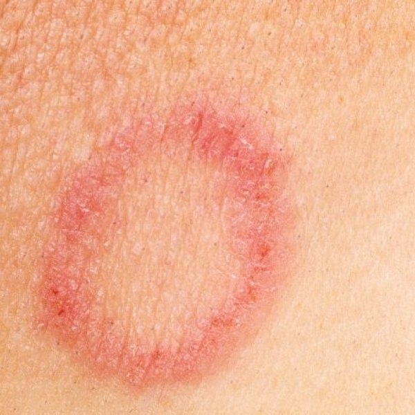 How to know if I have ringworm or eczema