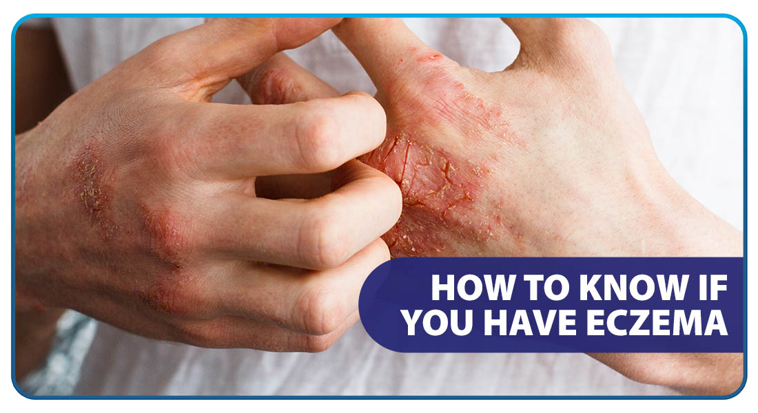 How to Know if You Have Eczema