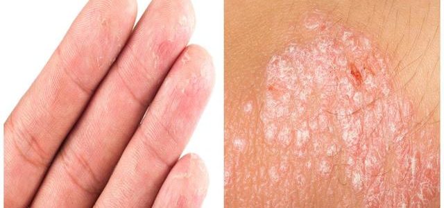 How To Know If You Have Psoriasis Or Eczema