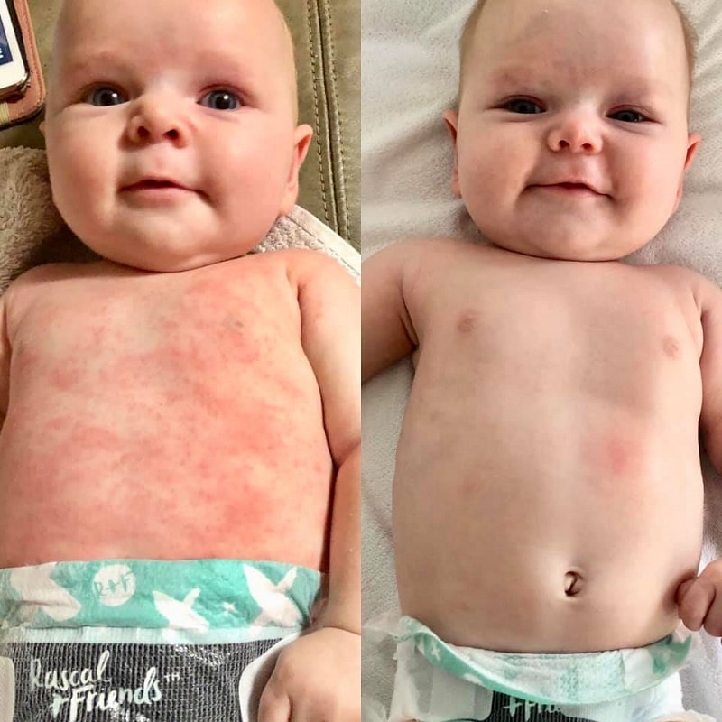 How to manage eczema in babies