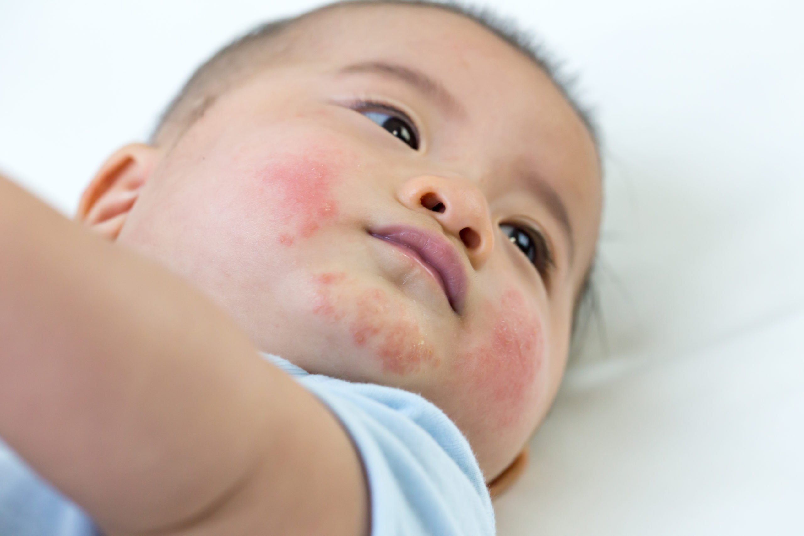 How to naturally ease babyâs eczema