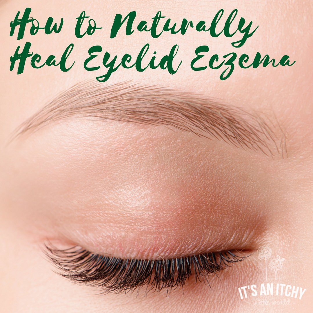 How to Naturally Heal Eyelid Eczema