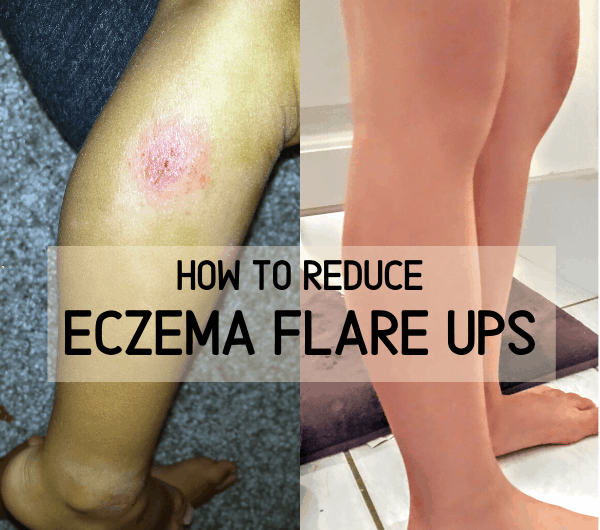 How to prevent eczema flare ups, 5 steps