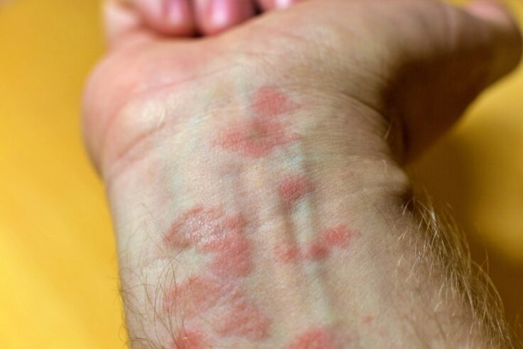 How To Reduce And Relieve Eczema Itching