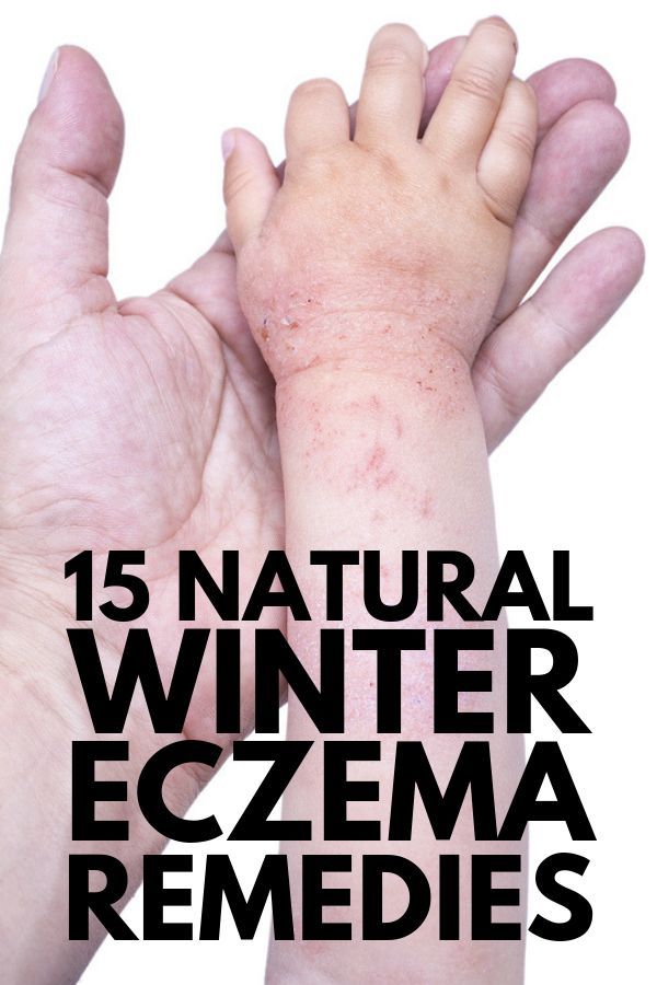 How to Relieve Eczema: 15 Best Products, Tips, and ...