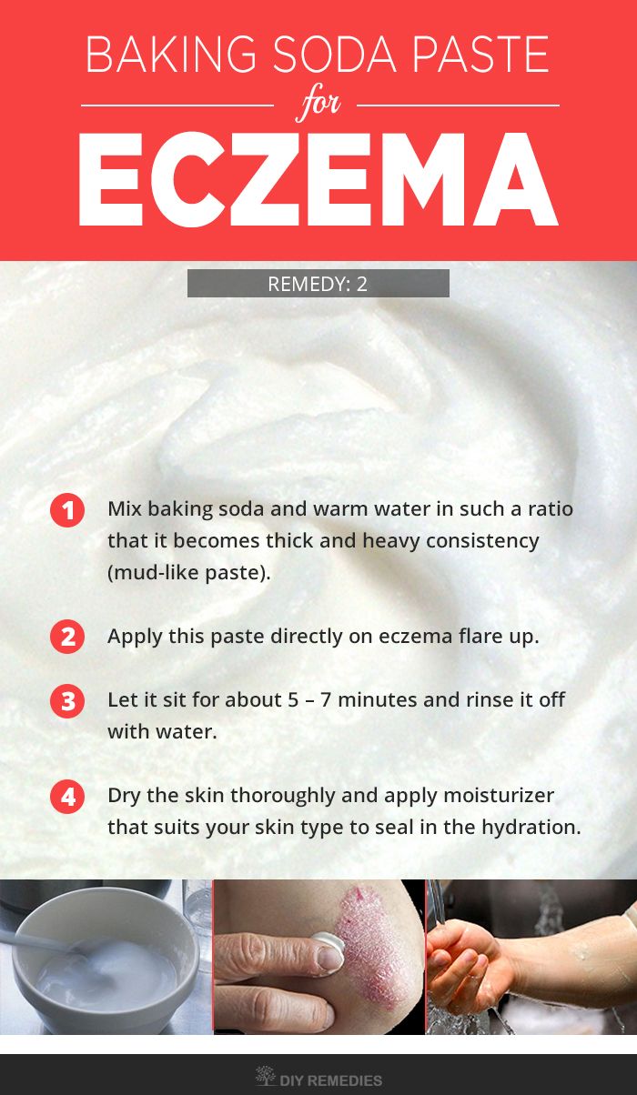 How to Soothe Eczema with Baking Soda
