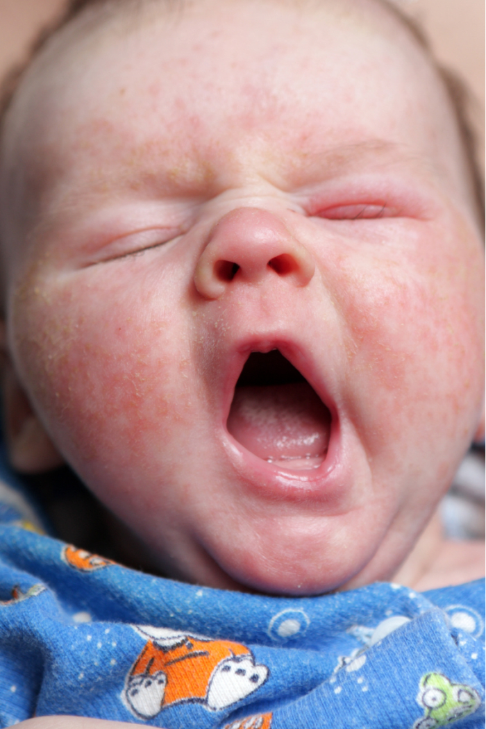 How to Spot and Treat Baby Eczema