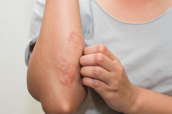 How to stop itching your skin if you have eczema