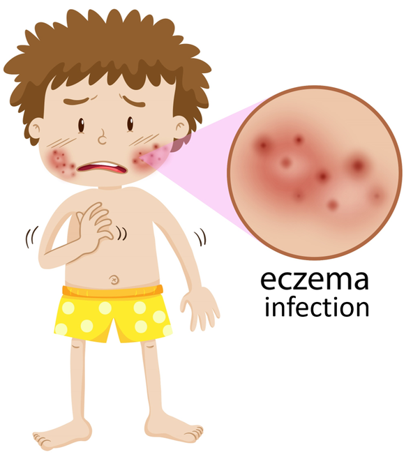 How to tell if my eczema is infected