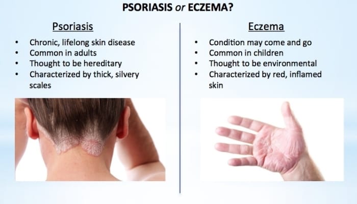 How to Tell If You Have Eczema or Psoriasis (and how to ...