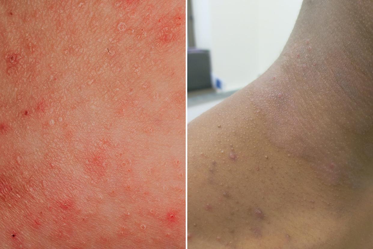 How to Tell the Difference Between Psoriasis, Rosacea, and ...