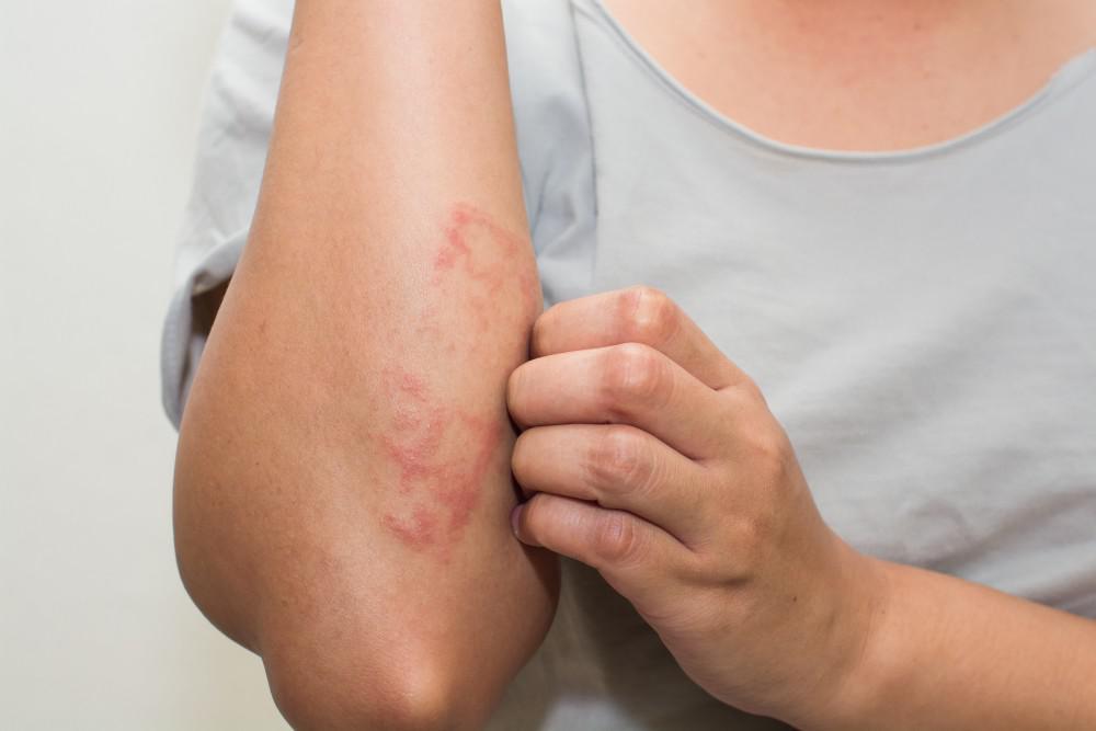 How to Tell Whether That Itchy Rash is Eczema or Psoriasis: HK ...