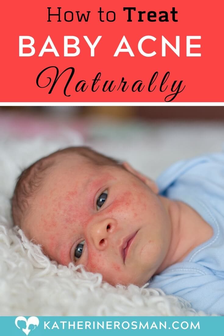 How to Treat Baby Acne Naturally at Home with Proper ...