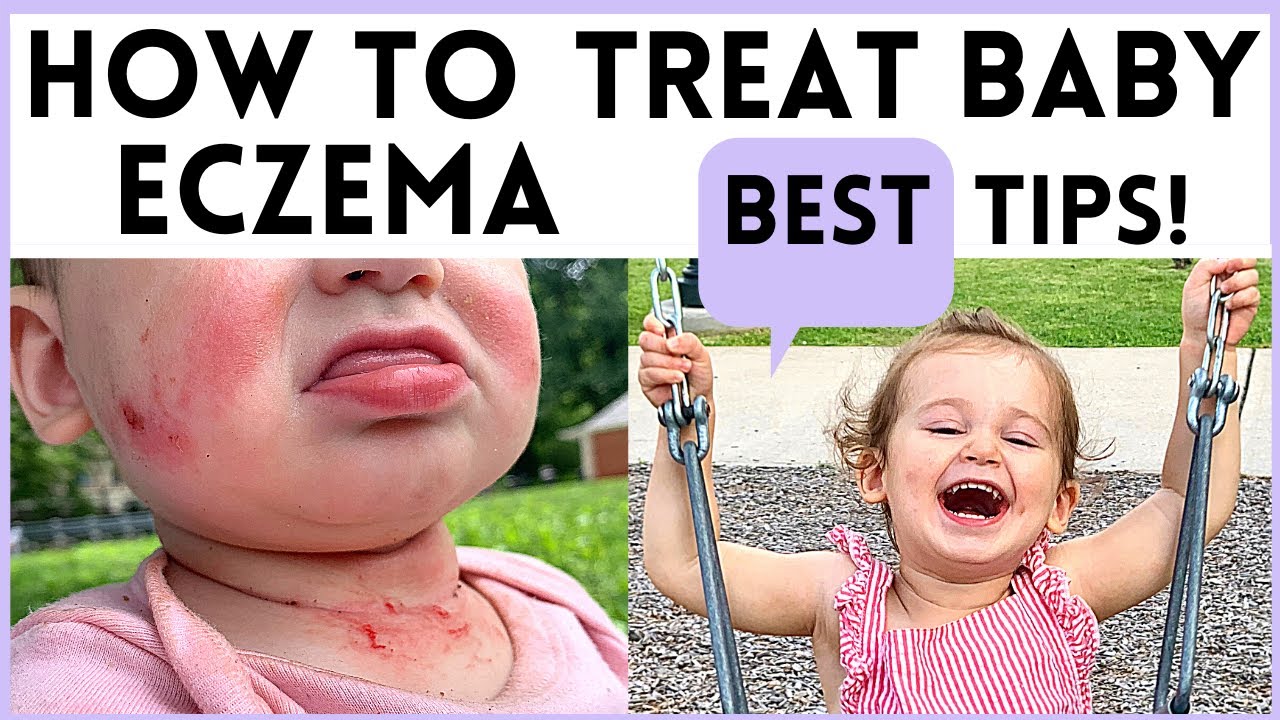 HOW TO TREAT BABY ECZEMA AT 2020 I BEST TIPS