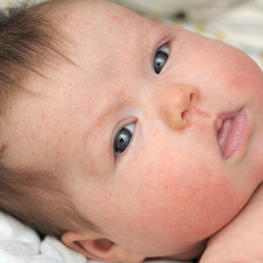 How to treat Baby Eczema