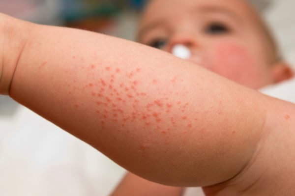How to Treat Baby Eczema in the Summer