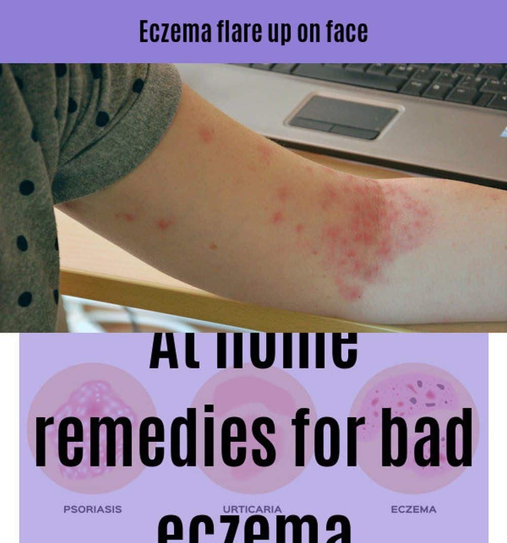How To Treat Bad Eczema On Face  ho.modulartz.com