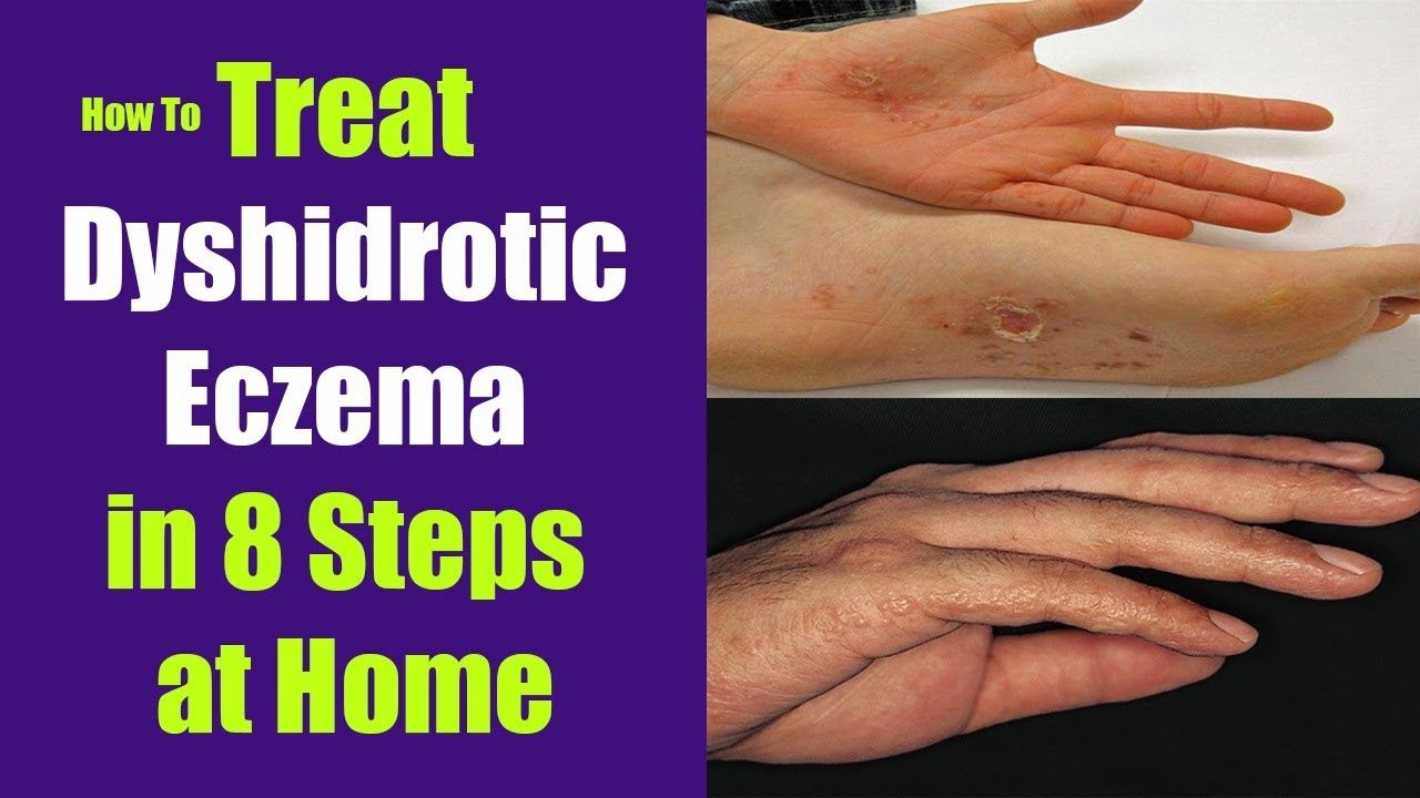 How to Treat Dyshidrotic Eczema in 8 Steps at Home