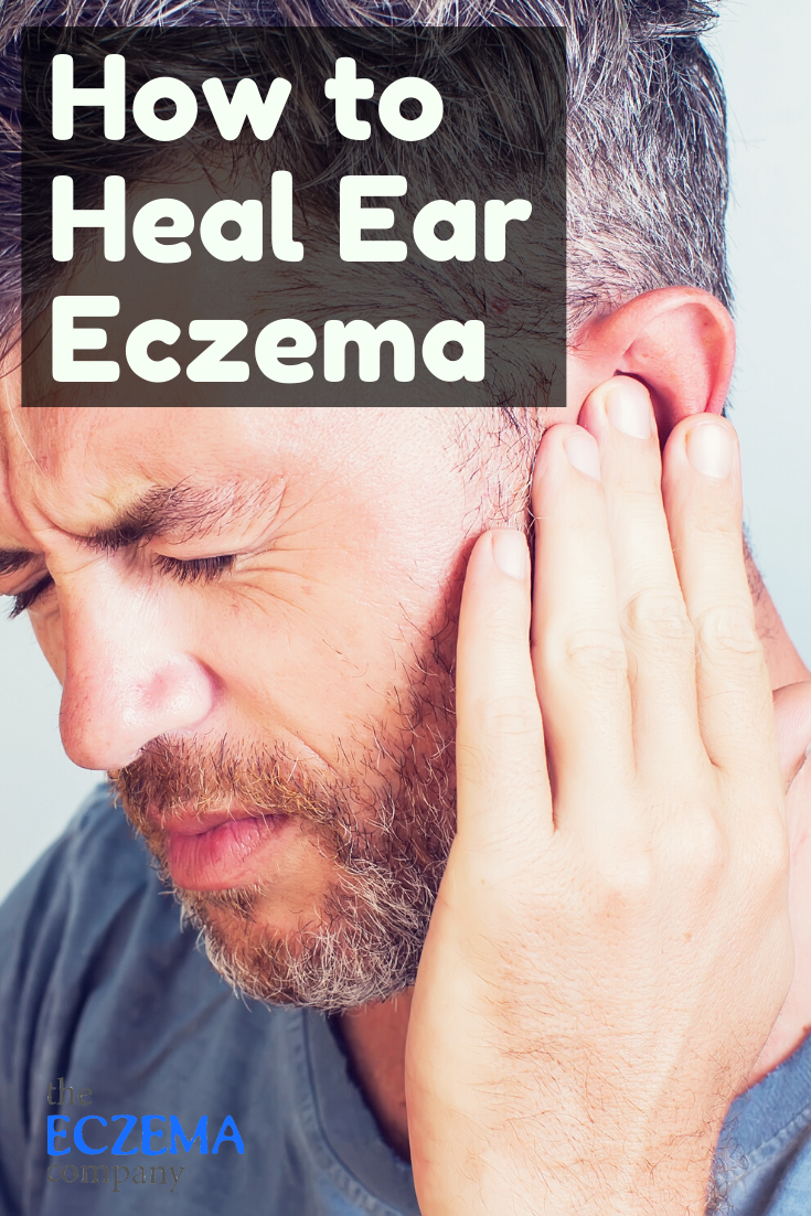 How to Treat Ear Eczema