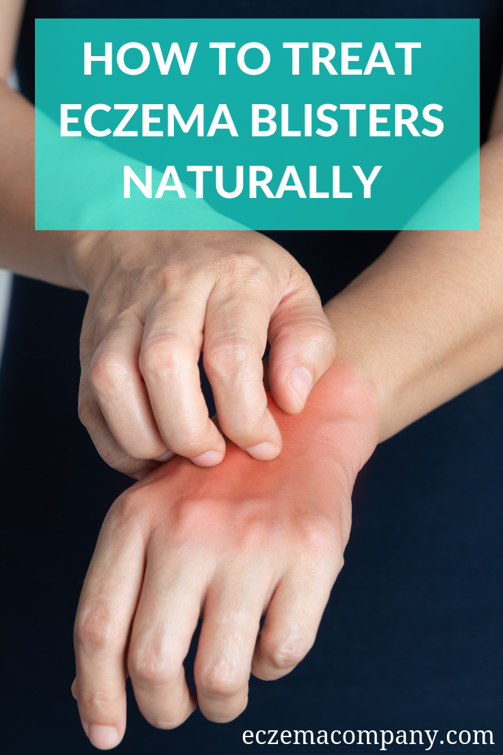 How to Treat Eczema Blisters Naturally