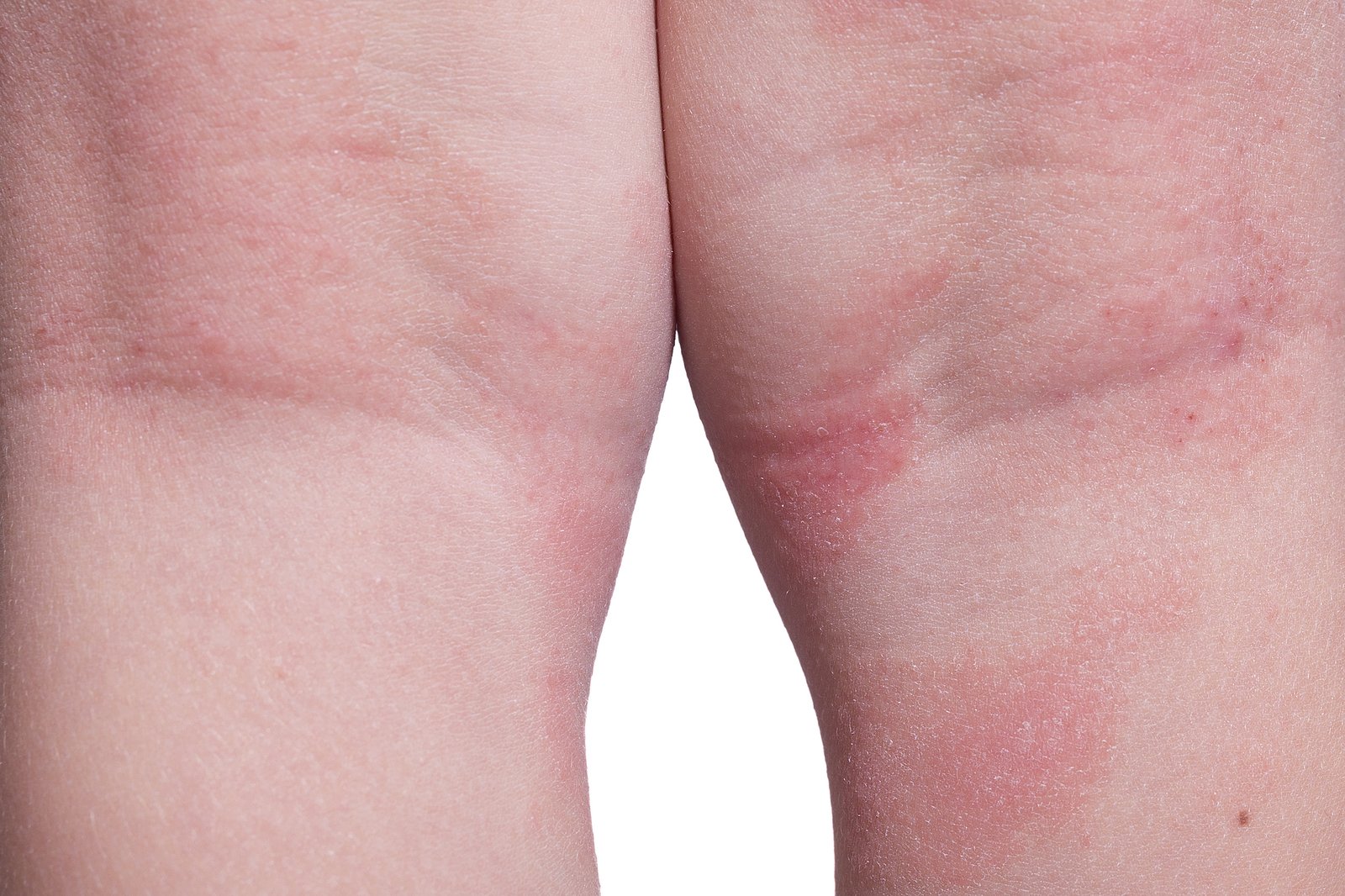 How to Treat Eczema from the Inside Out
