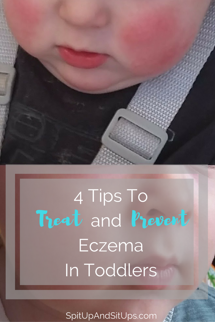 How To Treat Eczema in Toddlers and Babies