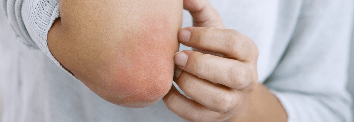 How to Treat Eczema on Elbows