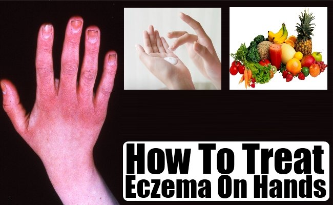How To Treat Eczema On Hands