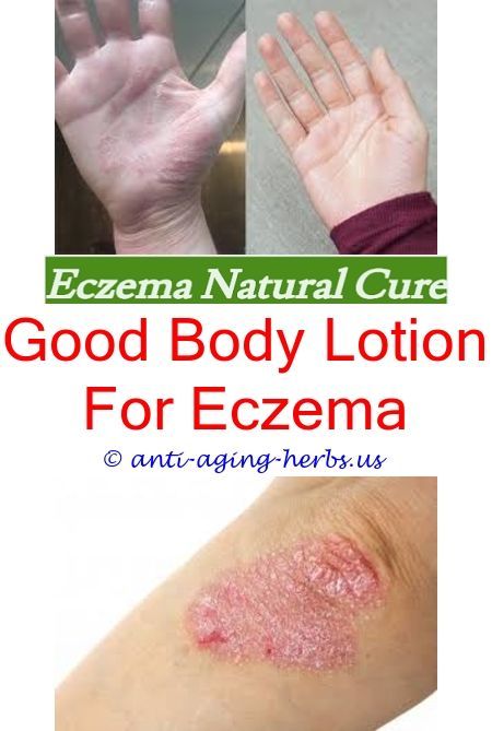 How To Treat Eczema On Hands