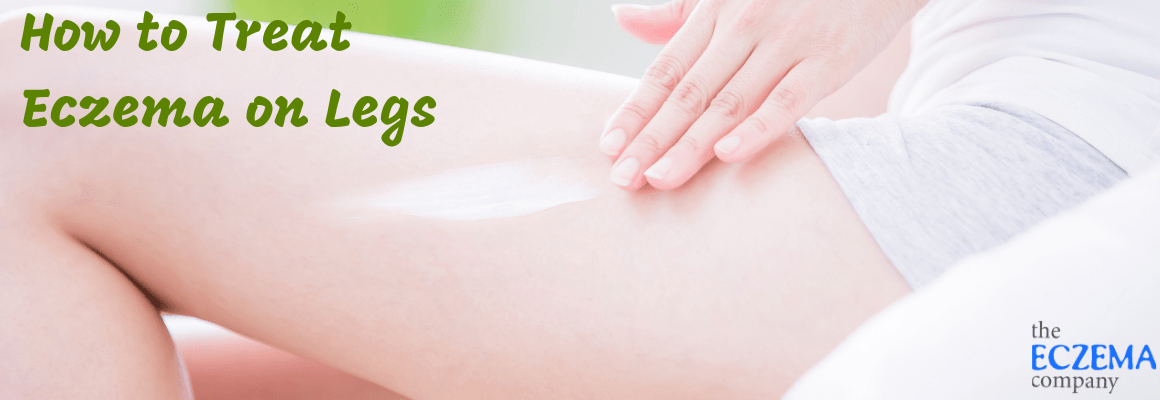 How to Treat Eczema on Legs