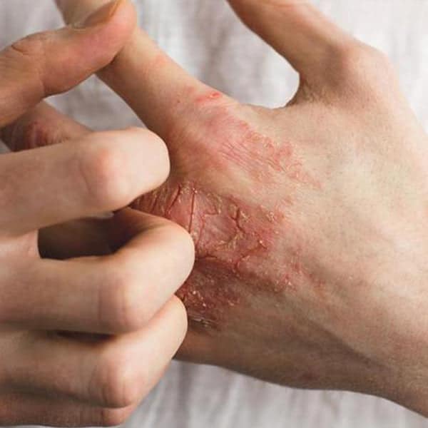 How to treat eczema on the hands