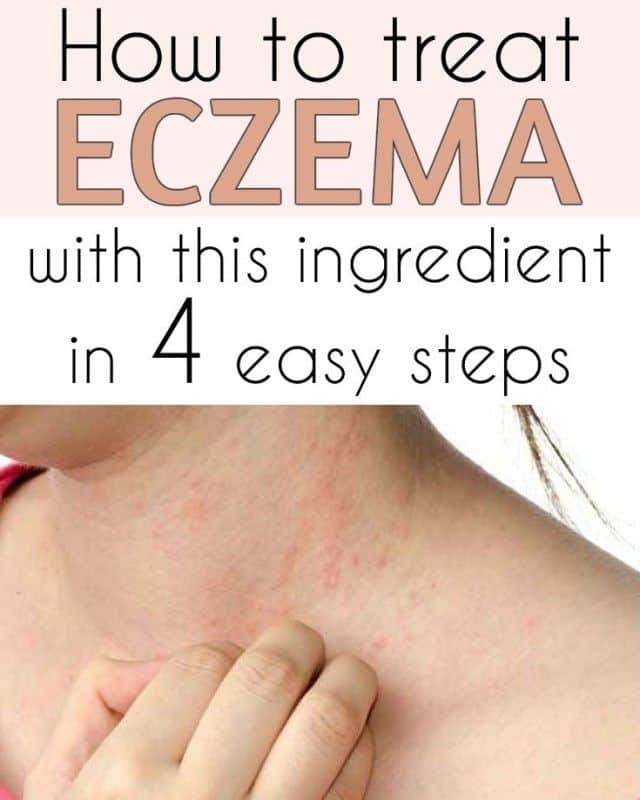 How To Treat Eczema While Pregnant