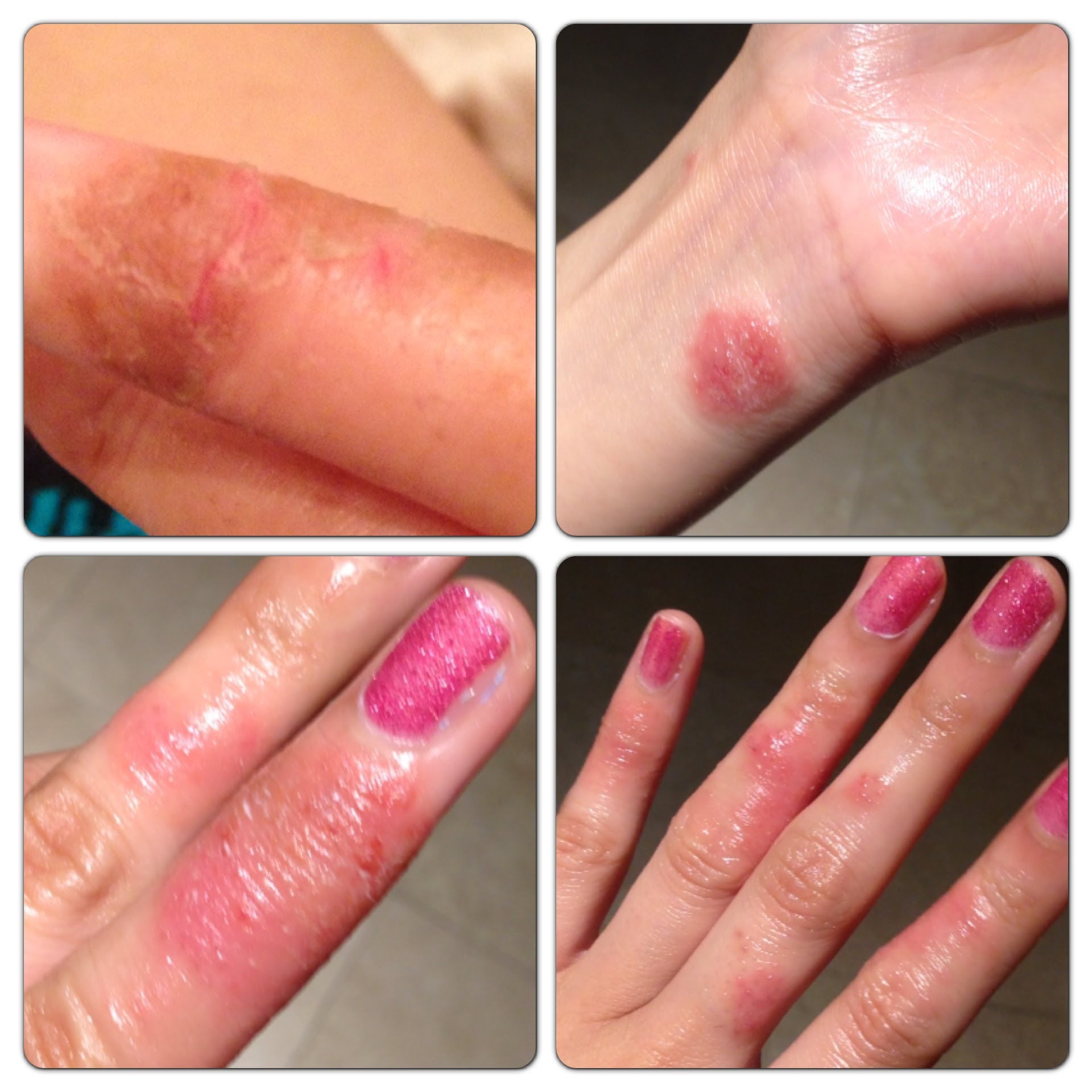 How to Treat Hand Eczema