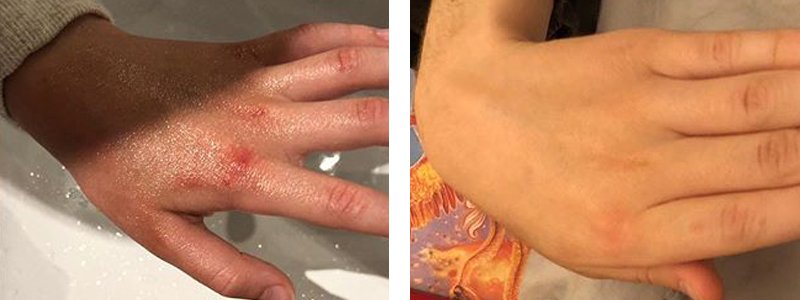 How to Treat Hand Eczema Naturally
