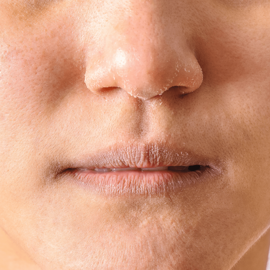 How to Treat Nose Eczema