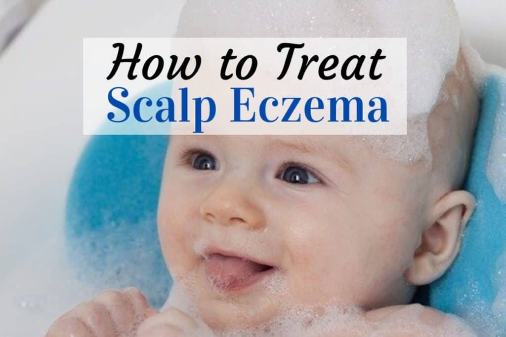 How to Treat Scalp Eczema in Babies?
