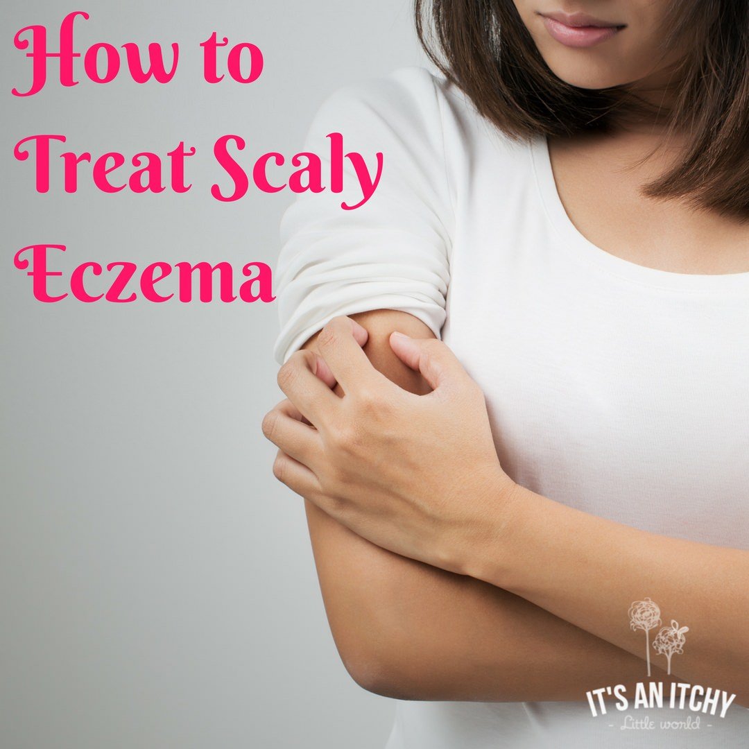 How to Treat Scaly Eczema