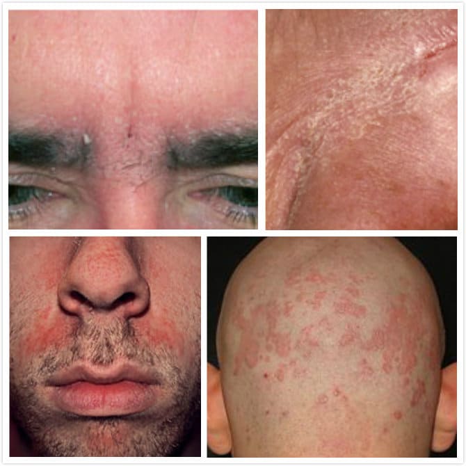 How to Treat Seborrheic Dermatitis on Face