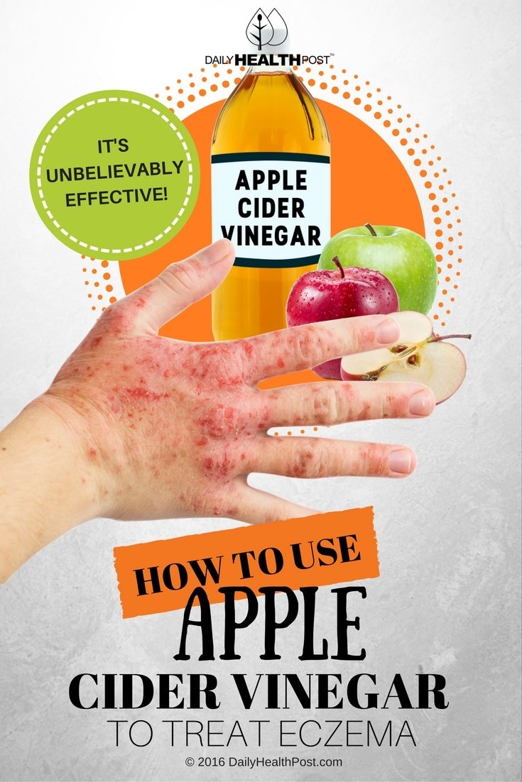 How To Use Apple Cider Vinegar To Fight Eczema Naturally