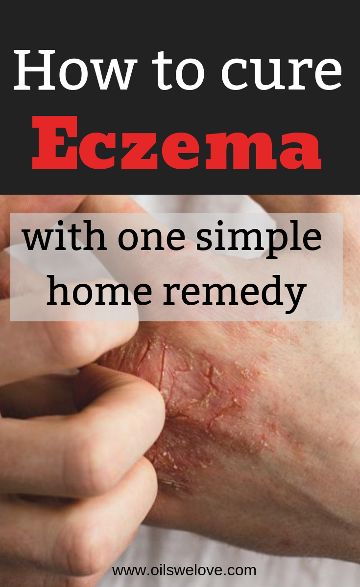 How to use manuka honey for eczema and cure it naturally