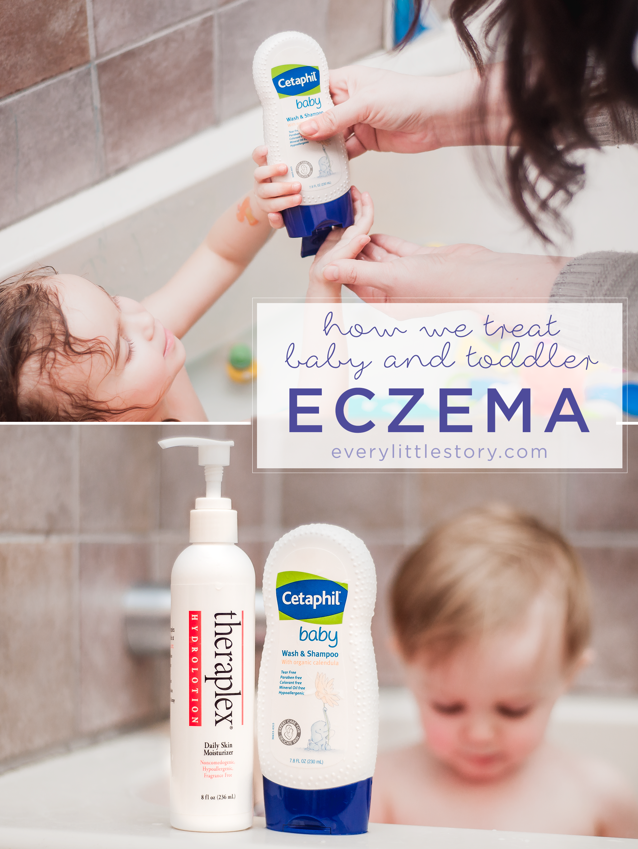 How We Treat Baby &  Toddler Eczema