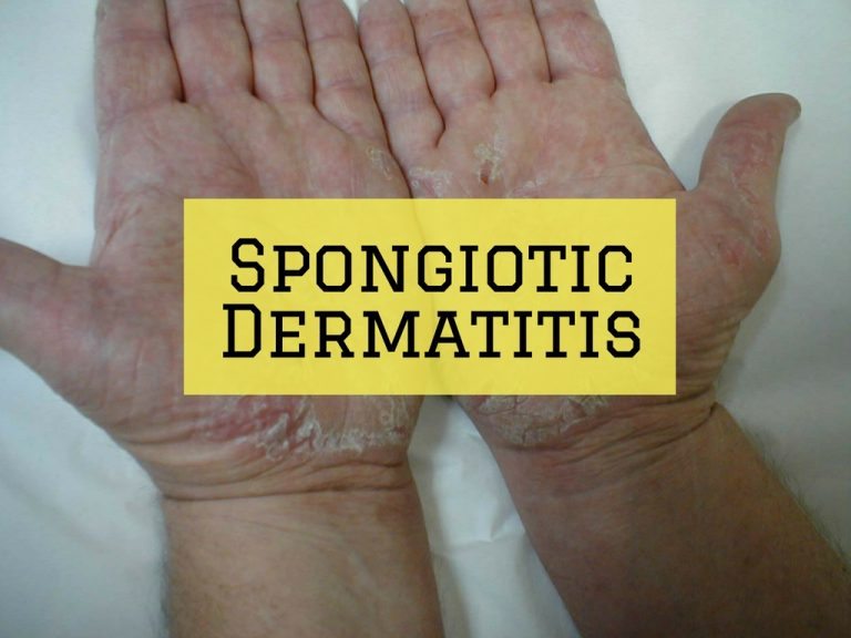 hronic spongiotic dermatitis treatment