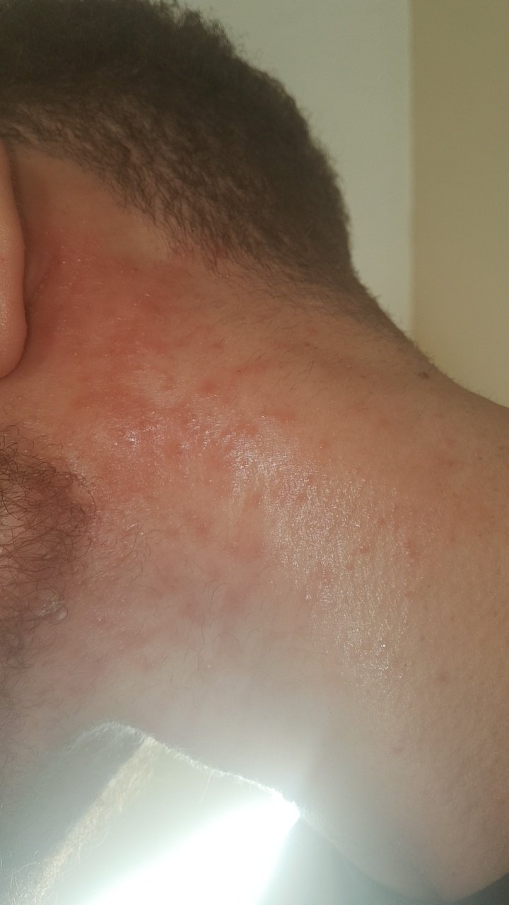 Huge itchy rash/eczema appeared on neck towards the end of ...