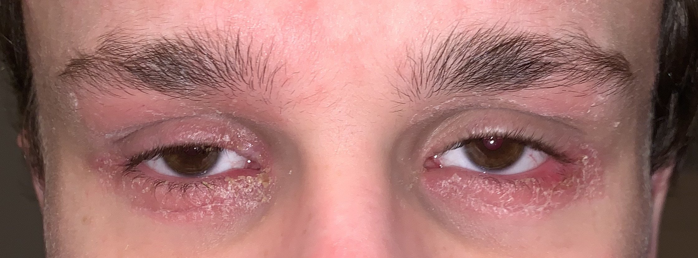 I can hardly open my eyes anymore... : eczema