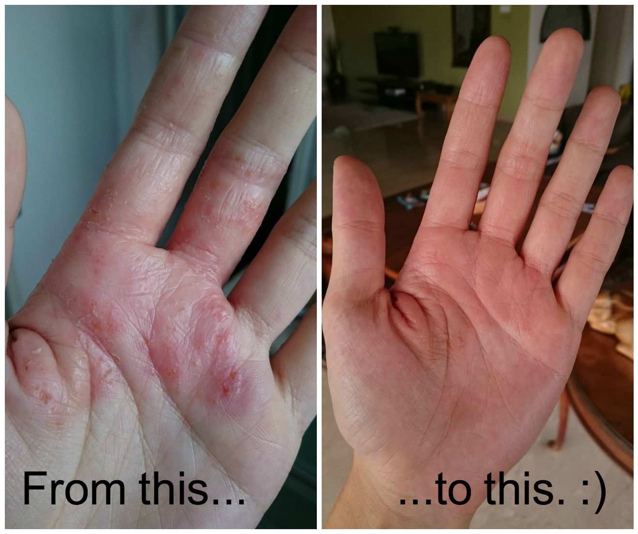 I Fixed My Eczema With Fish Oil! (With images)