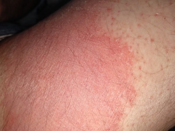 I have an embarrassing rash on my inner thigh! Any advice ...