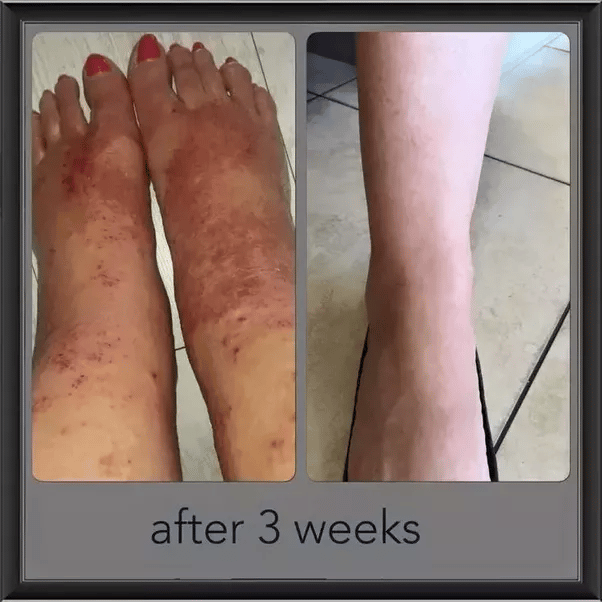 I have eczema along with vitiligo, what can I do?