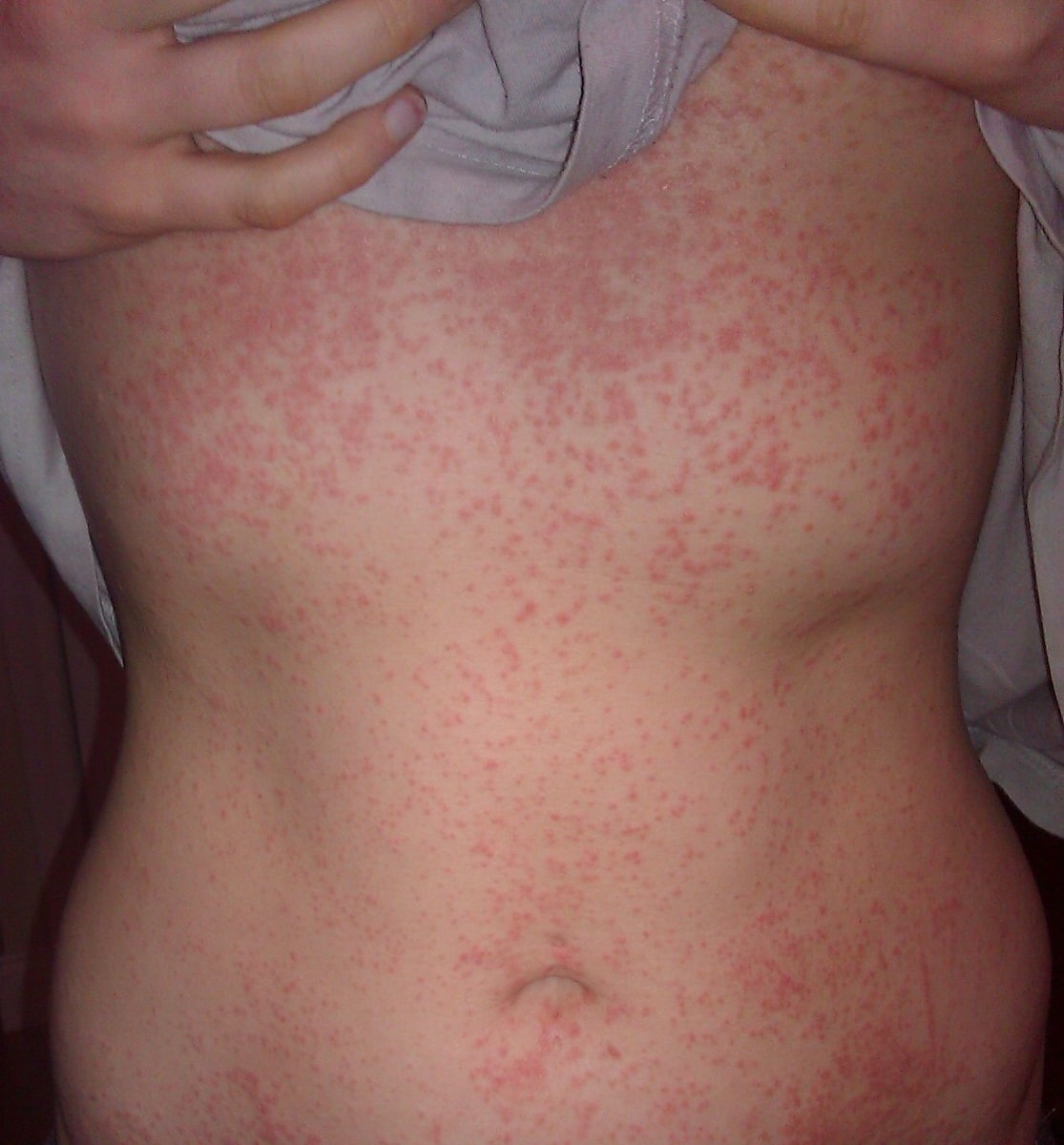 I Have Eczema: May 2013