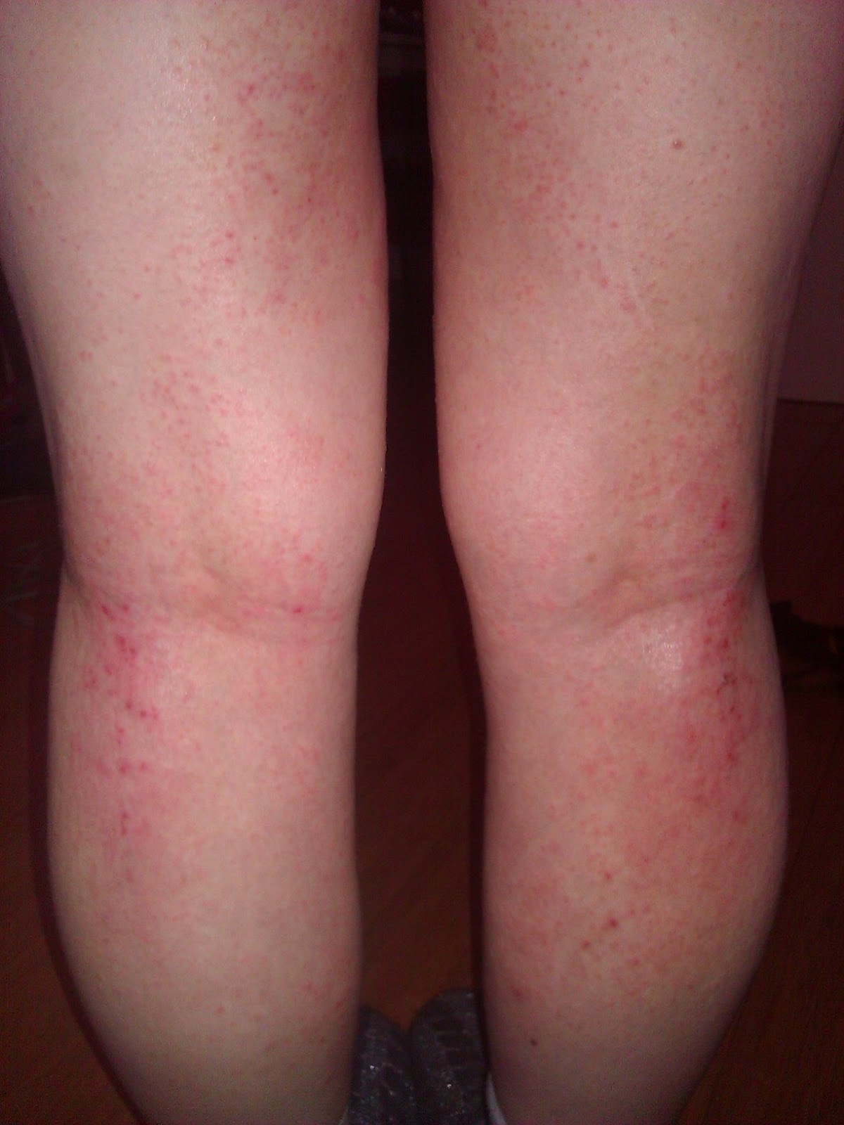 I Have Eczema: Topical Steroid Withdrawal